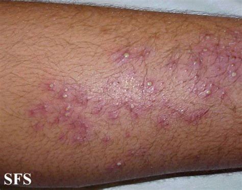 List Of Itchy Rashes Hubpages