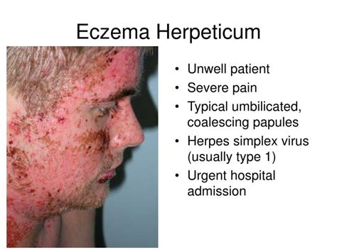 Ppt Eczema Powerpoint Presentation Id1349878