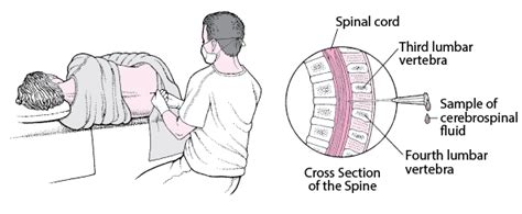Lumbar Puncture Spinal Tap Neurologic Disorders Msd Manual
