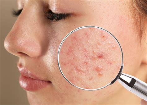 Fungal Acne Vs Closed Comedones How Can You Tell Beverly Wilshire