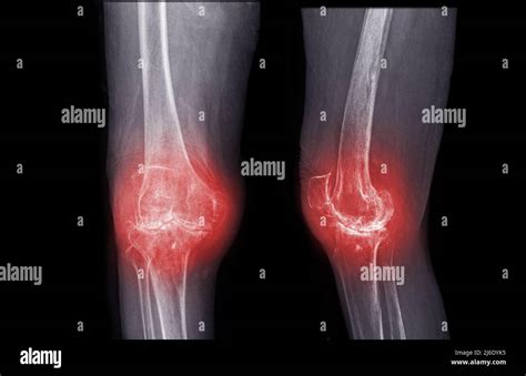 Film X Ray Knee Ap And Lateral View Of Osteoarthritis Knee Patient And