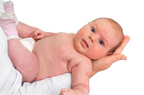 Babyakne Ursachen Und Abhilfe Für Neugeborenen Akne Windelnde