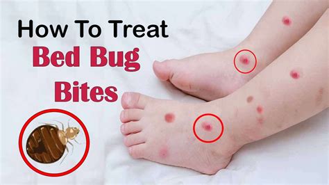How To Treat Bed Bug Bites On Babies Images And Photos Finder