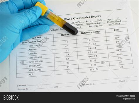 Liver Function Test Results