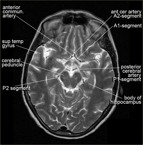Normal Ct Anatomy Of Brain
