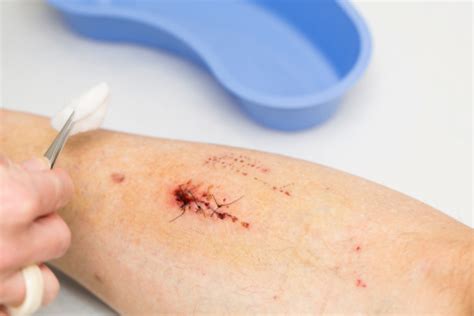 Nurse Is Removing Stitches From A Wound On Patients Leg Stock Photo