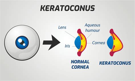 What To Know About Keratoconus Corneal Cross Linking See Clearly