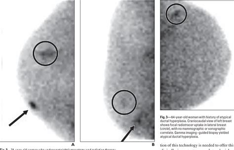 Figure 3—64 From Gamma Imaging Guided Minimally Invasive Breast Biopsy