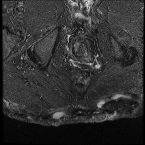 Hidradenitis Suppurativa Image