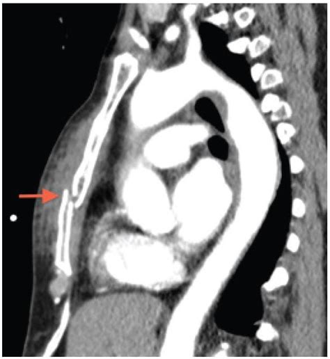 Ultrasound Of Sternal Fracture The Western Journal Of Emergency Medicine