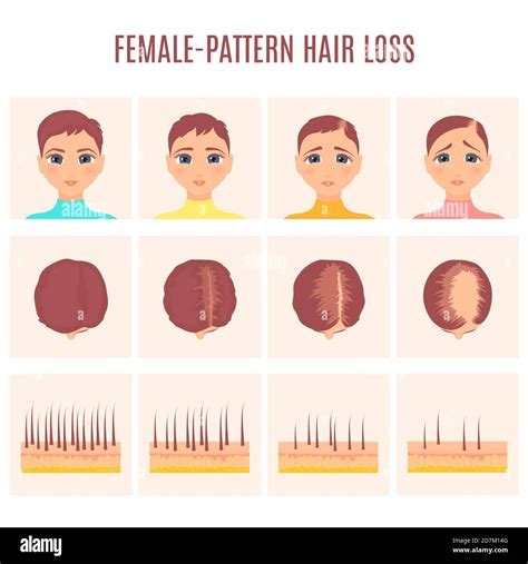 Female Pattern Hair Loss Illustration Stock Photo Alamy