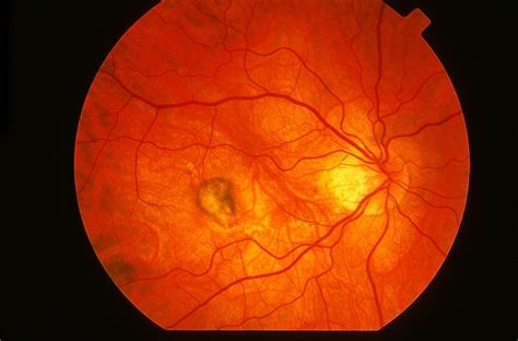 Myopic Cnv Retina Image Bank