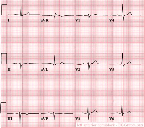 Left Anterior Fascicular Block Electrocardiogram Wikidoc