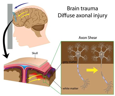 Dai (also referred to as traumatic axonal injury, or tai) is a type of traumatic brain injury (tbi) resulting from accelerating and decelerating motion there is no association between diffuse axonal injury and underlying skull fractures. Diffuse Brain Injury - Scottish Acquired Brain Injury ...