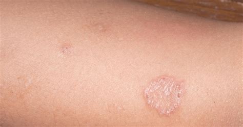 Itchy Red Circular Rash — It Could Be Ringworm