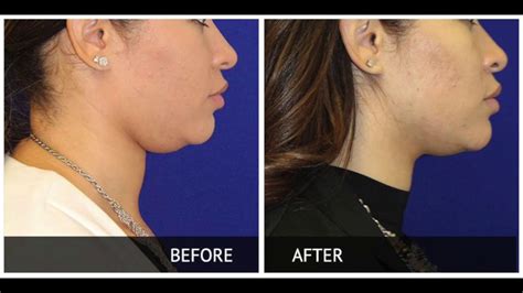 Kybella Injections With Before And After Youtube