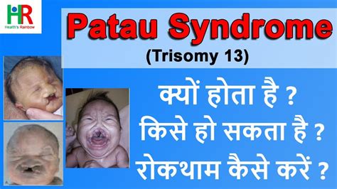 Patau Syndrome In Hindi Patatu Syndrome के प्रमुख कारण क्या हैं Symptoms Diagnosis