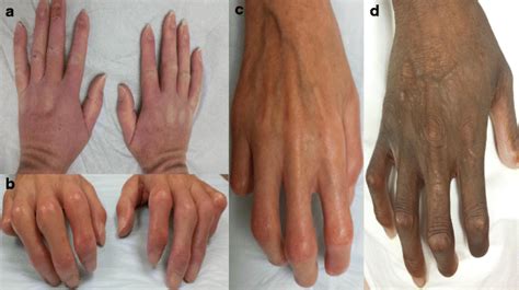 Hand Impairment In Systemic Sclerosis Various Manifestations And