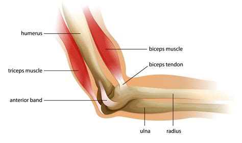 Forearm tendonitis is inflammation of the tendons of the forearm. Broken Arm - claim compensation from the CICA