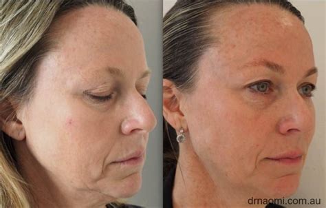 Jowls And Sag Injecting Dermal Filler To Improve The