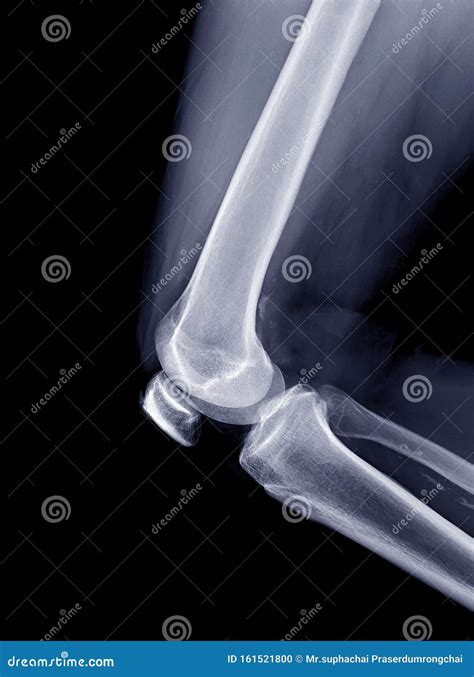 X Ray Image Of Right Knee Joint Lateral View Stock Photo Image Of