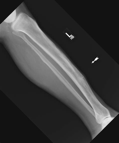Banana fracture (Paget disease) | Image | Radiopaedia.org