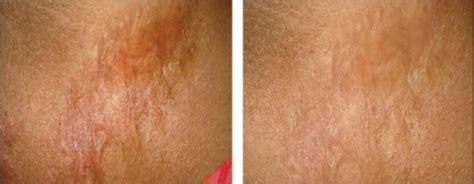A Patient With Burn Scar Before And After Treatment Open I