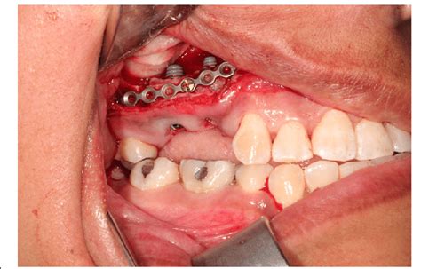 Vertical repositioning of dental alveolus segment with placement of ...