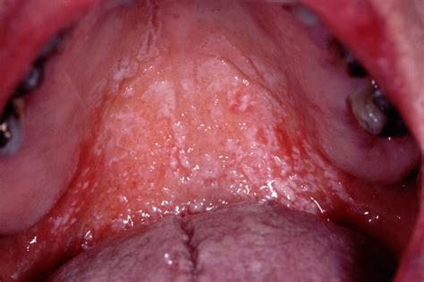 Differential Diagnoses Oral And Throat Infections Gponline