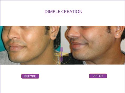Dimple Creation Surgery In South Delhi And Gurgaon Royallush
