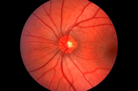Retinal Fundoscopy