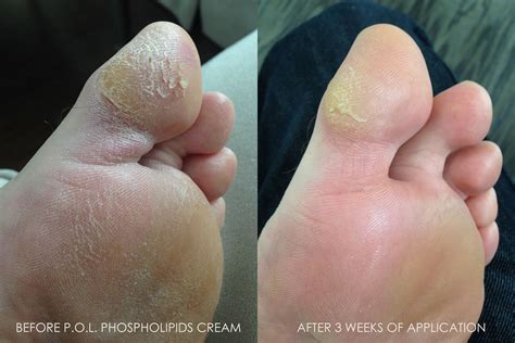 Cabot Pol Phospholipids Cream Heals And Prevents Dry Cracked Feet