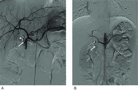Angiography Of Prophylactic Embolization Of The Gastroduodenal Artery