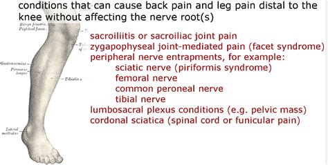Sciatica And Lumbosacral Radiculopathy Back Pain With Lower Extremity