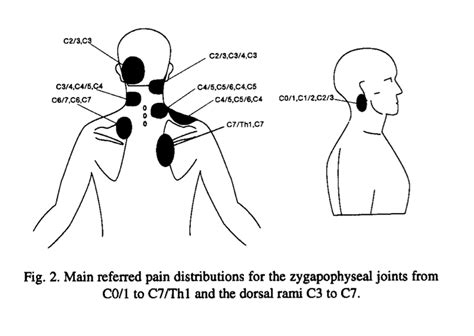 Cloward Sign And Cervical Referral Patterns Modern Manual Therapy Blog