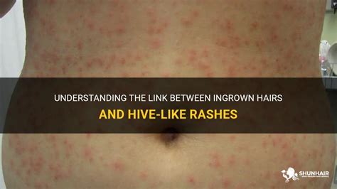 Understanding The Link Between Ingrown Hairs And Hive Like Rashes
