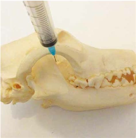 Placement Of The Needle For The Maxillary Nerve Block Should Be Where