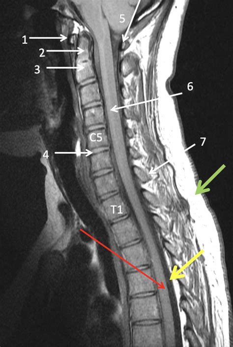 Sagittal Neck Mri Diagram Quizlet