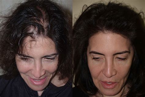 Hair Transplants For Women Photos Miami Fl Patient58205