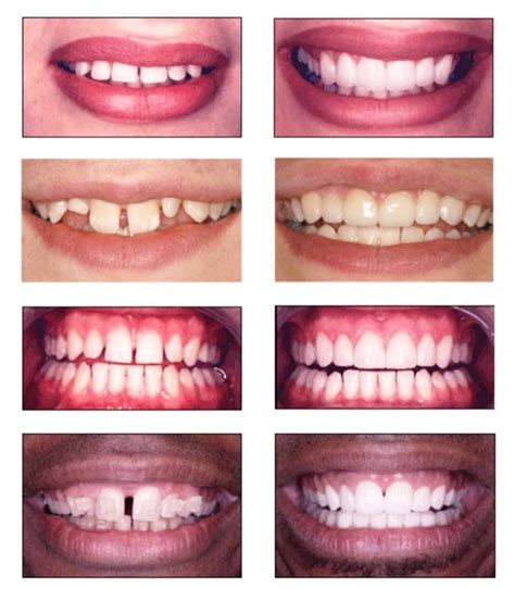Gaps And Spaces Between Teeth Dental Solutions Smile Concepts