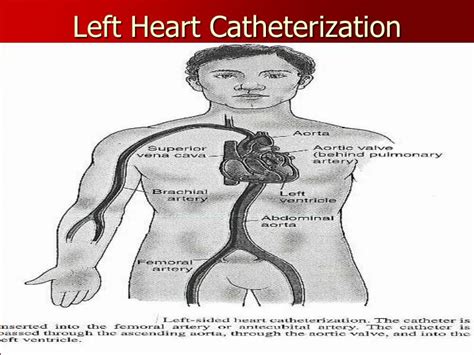 Lv Pressure Cardiac Catheterization Literacy Basics