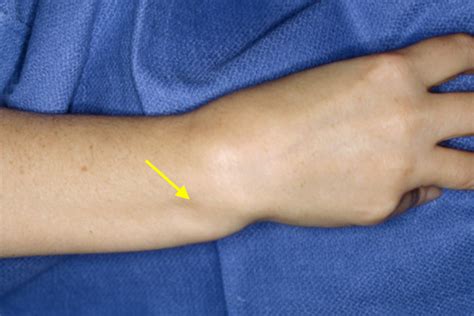 DISLOCATION WRIST DISTAL RADIAL ULNAR JOINT DRUJ Hand Surgery Resource
