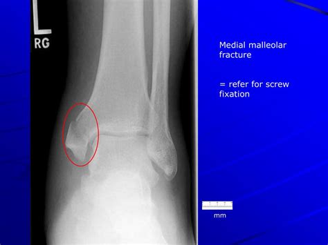 Ppt X Ray Rounds Plain Radiographic Evaluation Of The Ankle