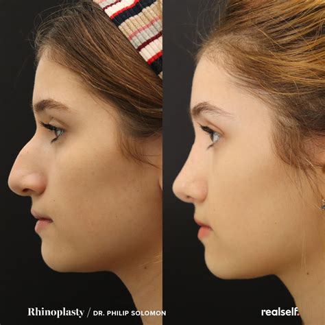 Plastic Surgery Rinoplastia Rhinoplasty Before And After In
