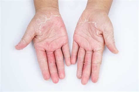 Dry Skin On Feet Causes Symptoms Home Remedies