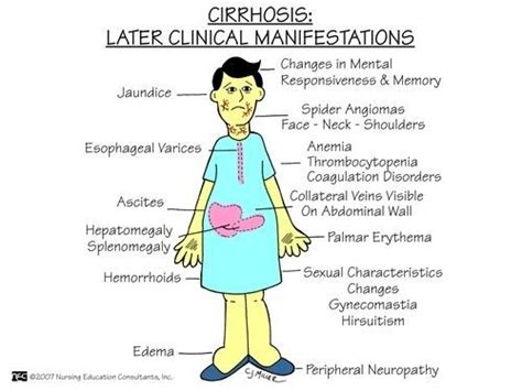 Liver Cirrhosis Signs And Symptoms Healthcare Infographics