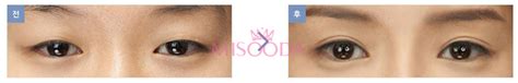 why korean eyelid surgery guide reviews images promotions misooda