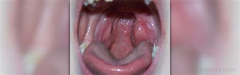 Swollen Tonsils Symptoms Remedies And Treatment General Center