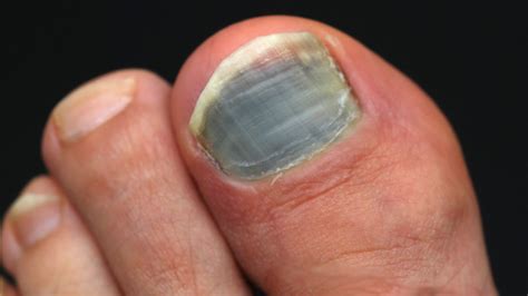 Black Toenails Causes And How To Get Rid Of Them Starts At 60