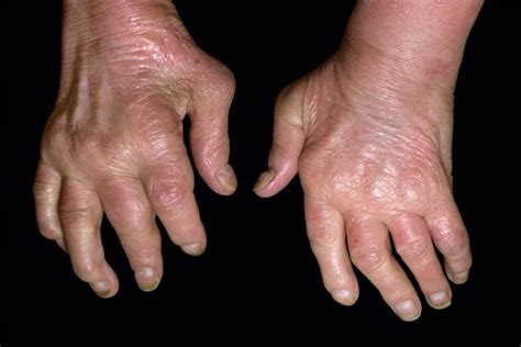 Psoriatic Arthritis Symptoms Improved With Apremilast Monotherapy